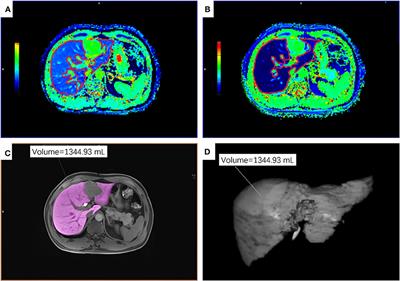 Assessing Liver Function in Liver Tumors Patients: The Performance of T1 Mapping and Residual Liver Volume on Gd-EOBDTPA-Enhanced MRI